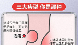 【欽二醫(yī)技術(shù)】?jī)?nèi)鏡下微創(chuàng)治療 解除有“痔”之士的困擾