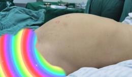 【欽二醫(yī)技術(shù)】單孔腹腔鏡下切除巨大卵巢腫瘤 抽出囊液8500ml